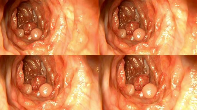 肠息肉肠镜微创手术恶性