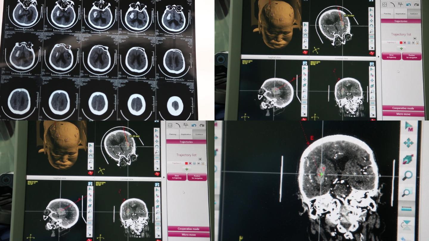脑ct 开颅手术 帕金森