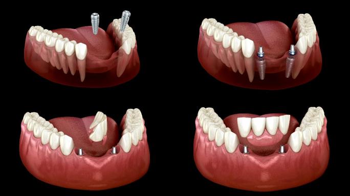 种植体前牙桥按牙动画假牙安装