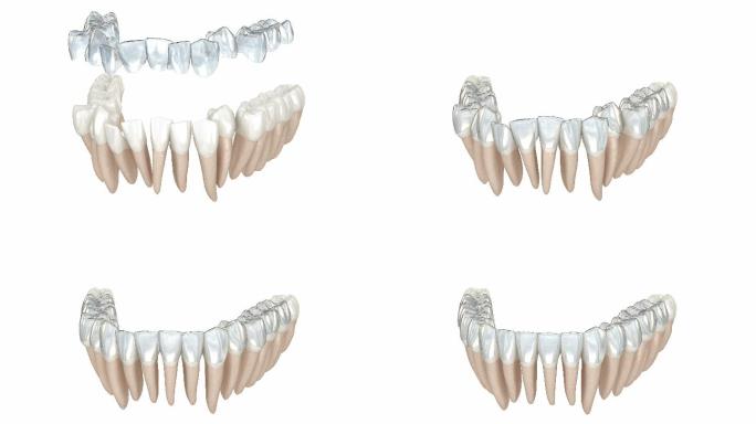 医学牙齿3D动画