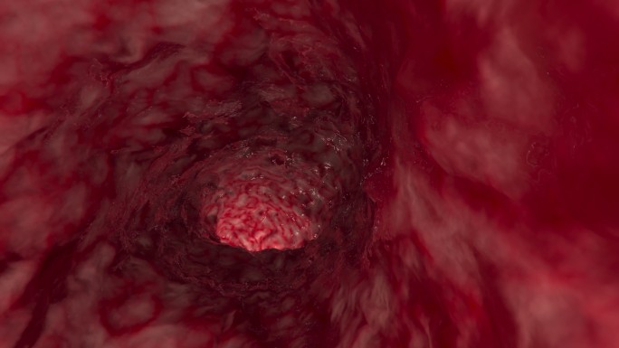 动脉或肠内3D演示胃肠消化内科