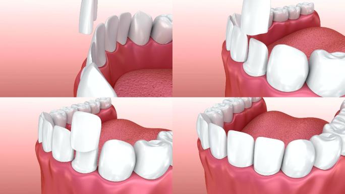 牙齿安装三维动画