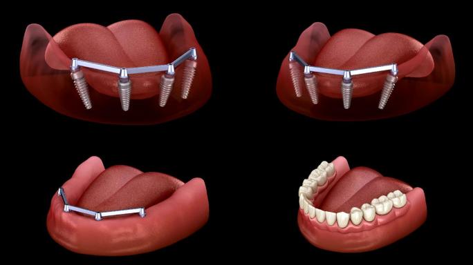 可拆卸下颌骨假体补牙修牙种牙拔牙医生矫正