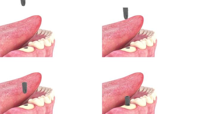 种植牙手术钻针钻孔口腔手术动画步骤演示