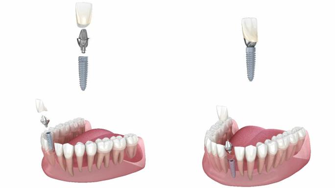 定制种植基牙和种植体安装过程