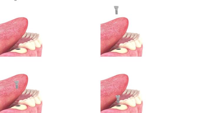 种植牙手术钻针钻孔口腔手术动画步骤演示