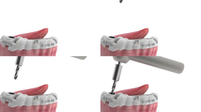 种植牙手术钻针钻孔口腔手术动画步骤演示