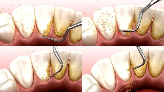人体牙齿治疗的3D动画