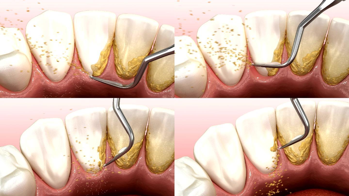人体牙齿治疗的3D动画