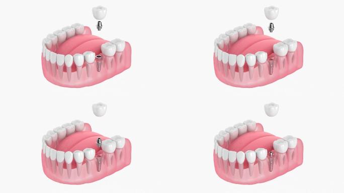 种植牙牙医医院3D动画演示种牙修牙补牙手