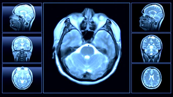 核磁共振扫描CT脑部医疗