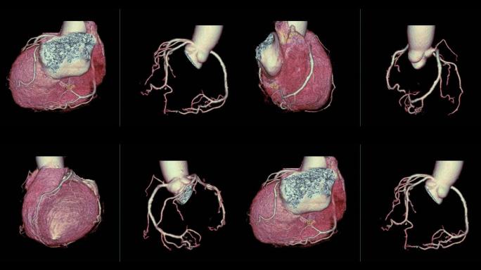 CTA冠状动脉3D渲染图像