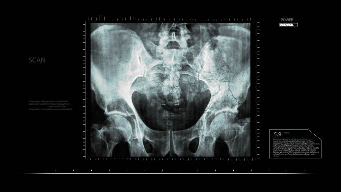 骨盆X光片