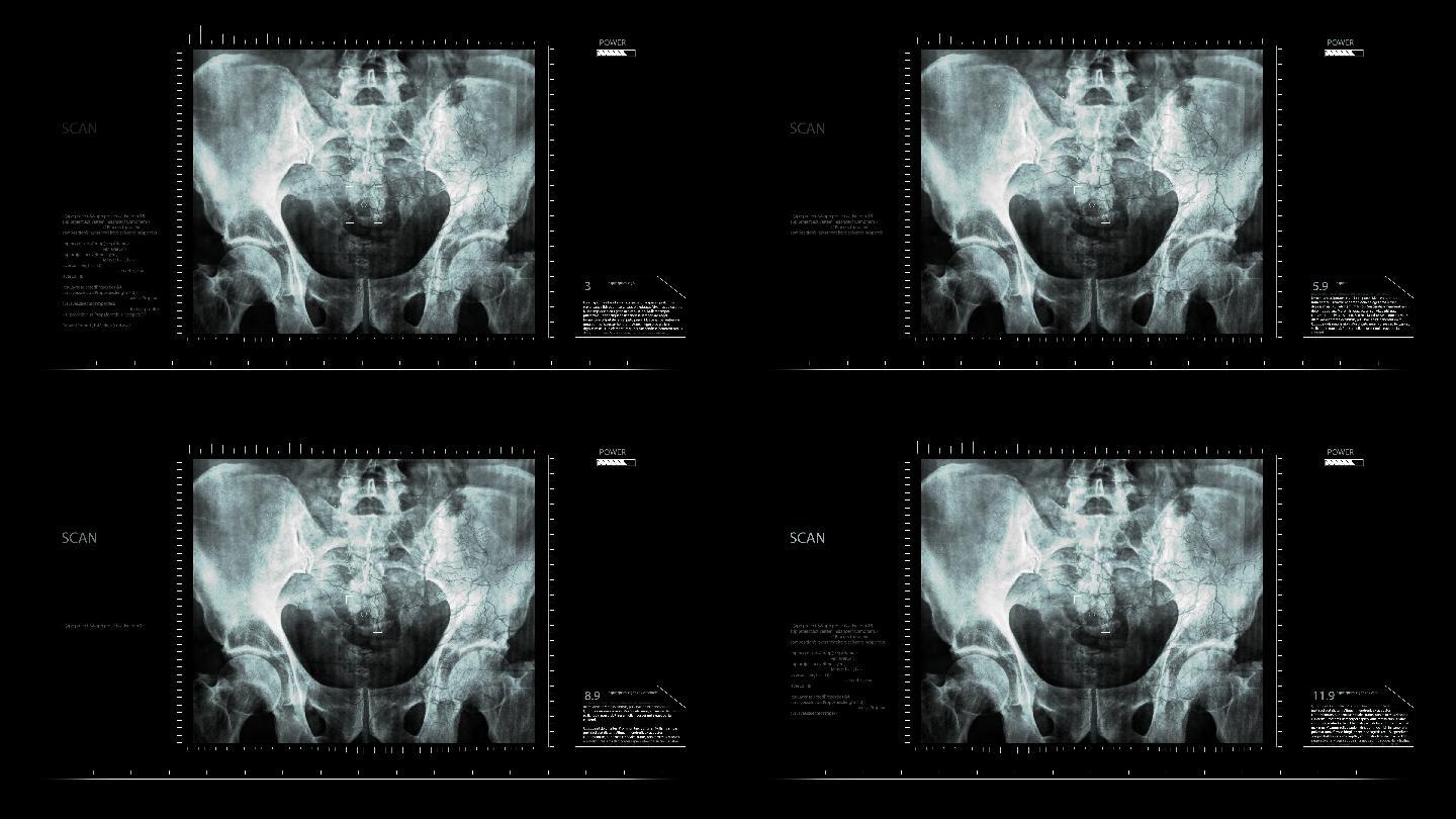骨盆X光片