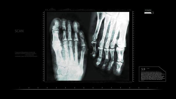 脚部的X光片