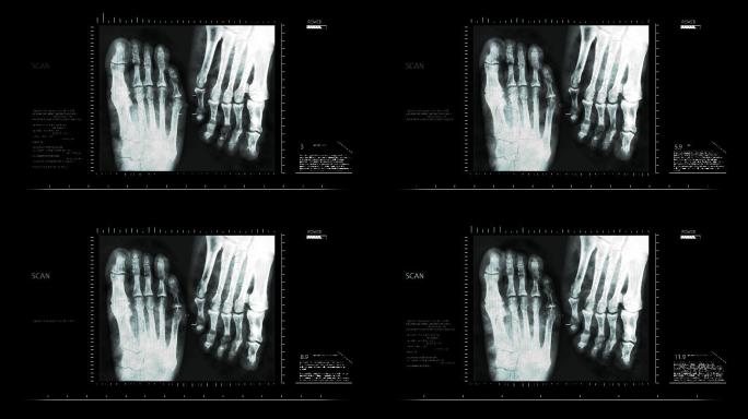 脚部的X光片