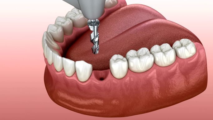 种植过程细节动画口腔防蛀美白牙医牙齿防护