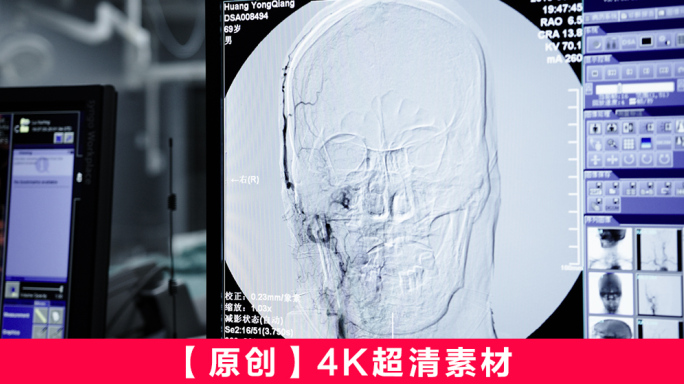 中风脑卒中取栓血管手术