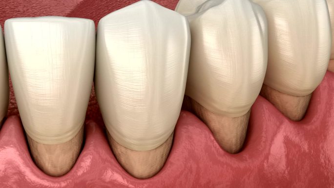 牙龈衰退过程补牙修牙种牙拔牙矫正专家