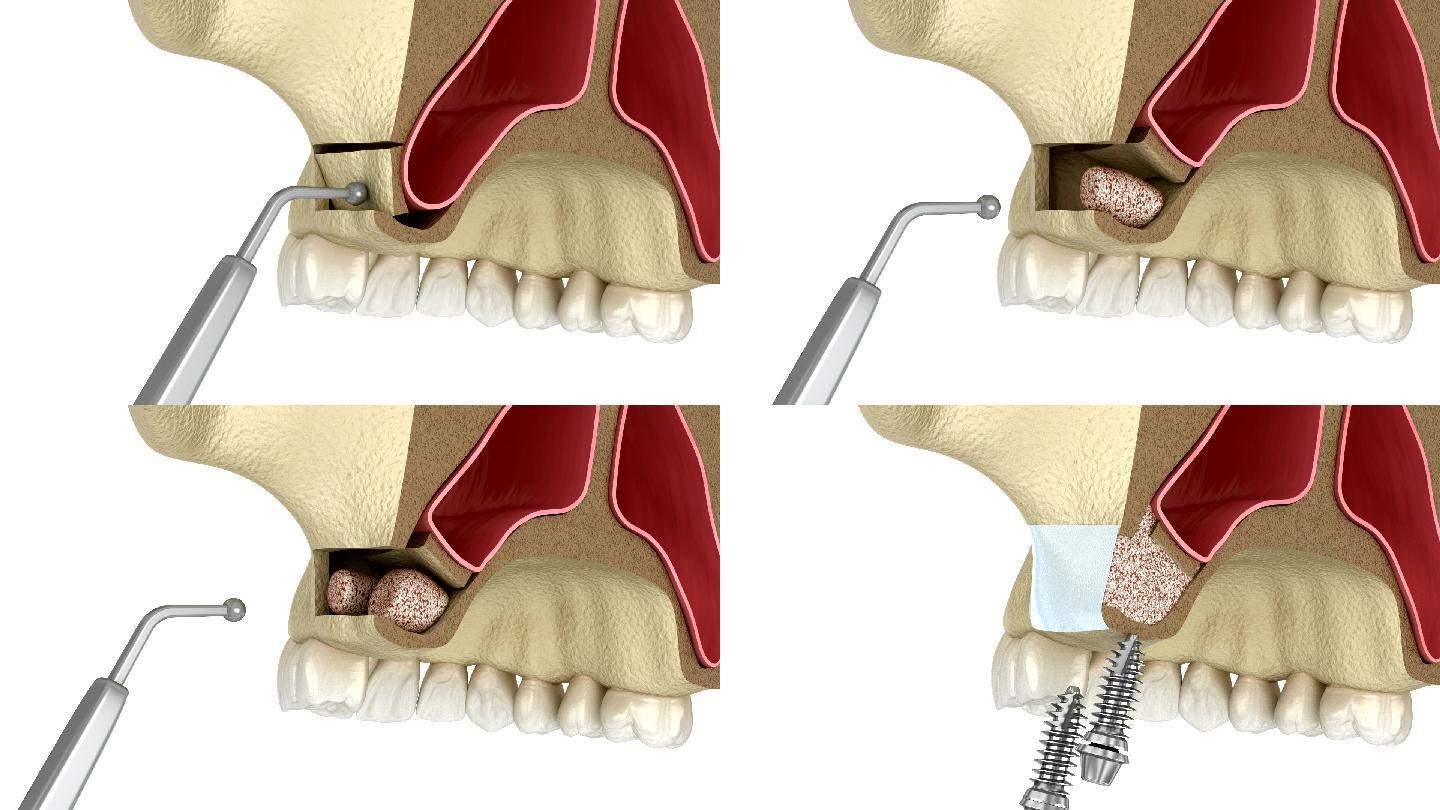 侧入路鼻窦提升术。牙科手术的三维动画