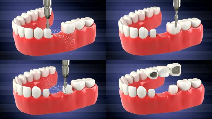 显示牙桥安装过程的高质量3D动画。