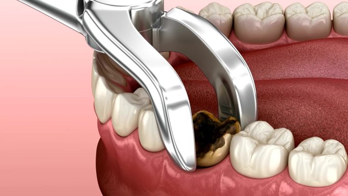 拔除龋齿蛀牙牙科动画牙齿保护换牙种牙口腔