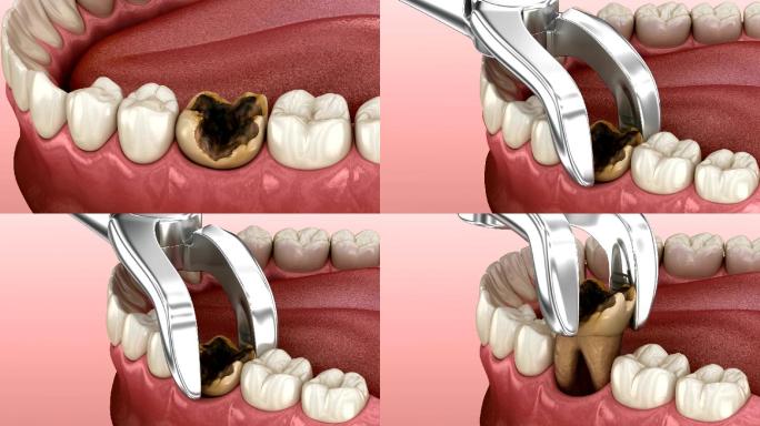 拔除龋齿蛀牙牙科动画牙齿保护换牙种牙口腔