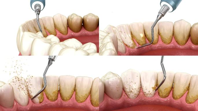 人体牙齿治疗的医学精确3D动画