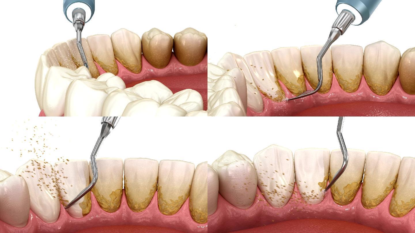 人体牙齿治疗的医学精确3D动画