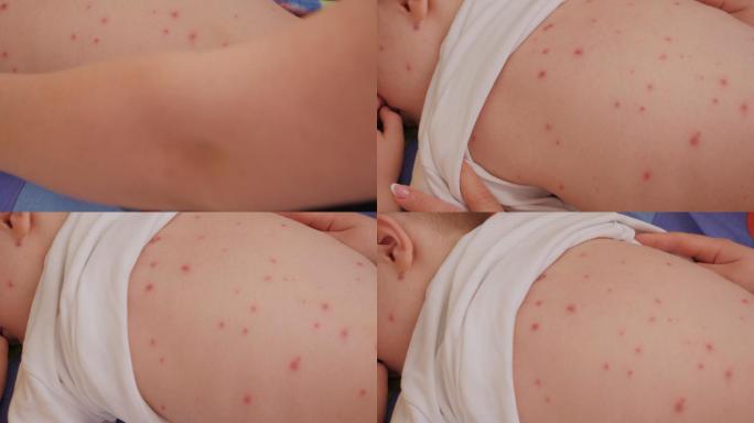 一位母亲检查水痘患儿发炎皮肤的特写镜头。