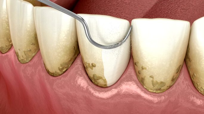 口腔卫生：常规牙周治疗