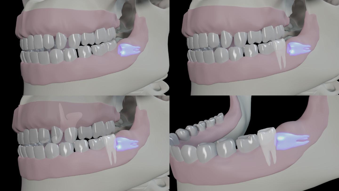 阻生智齿三维口腔三维牙床口腔问题