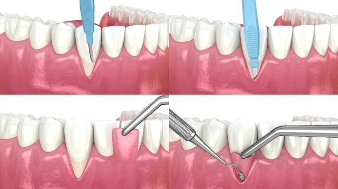 牙科手术的三维动画