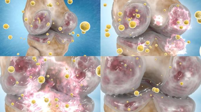 骨病修复关节软骨滑液