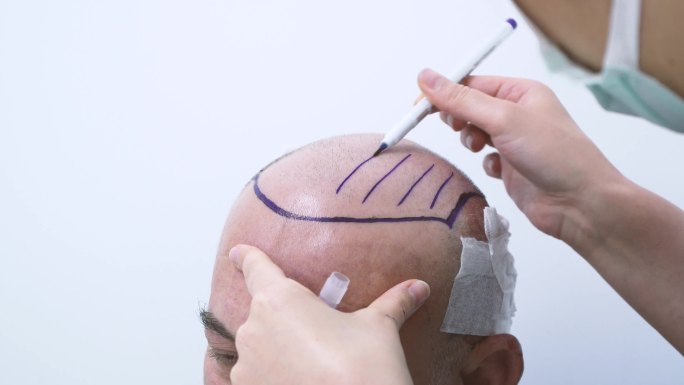 医生用铅笔画出这个男人的头以备头发移植