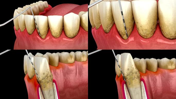 医学上的3D动画牙疼洗牙补牙修牙牙医矫正