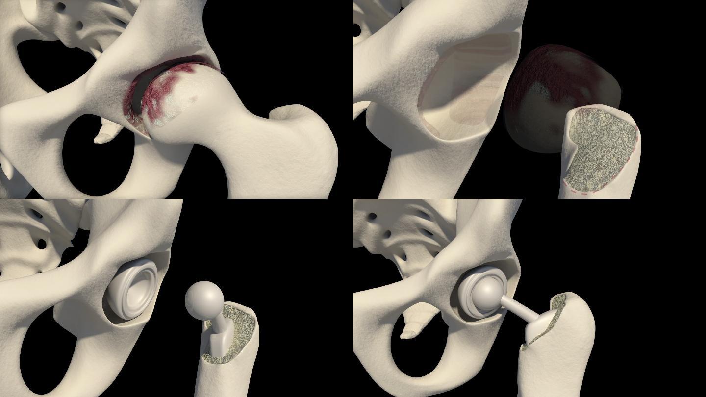 全髋关节置换术三维骨质疏松骨骼骨头