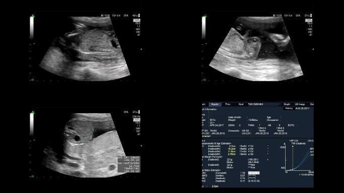 超声检查孕期定期检查婴儿胎儿B超胎心跳动