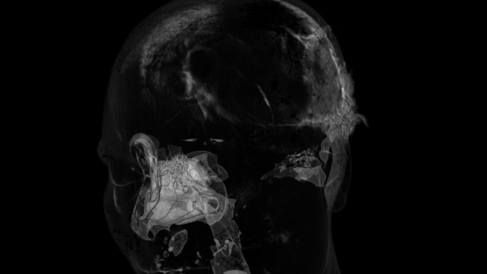 颞骨CT高清视频素材