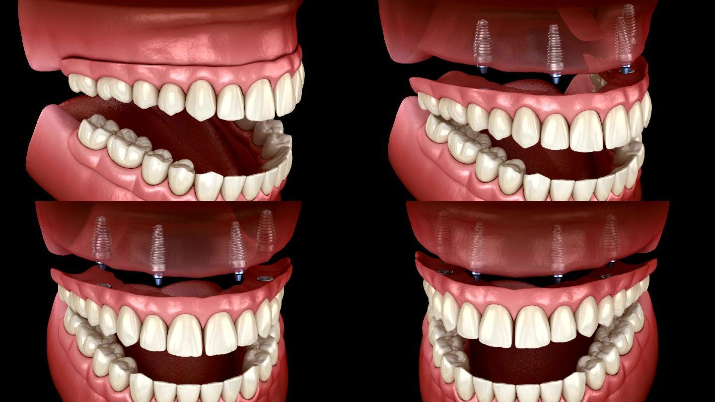 人体牙齿和假牙概念