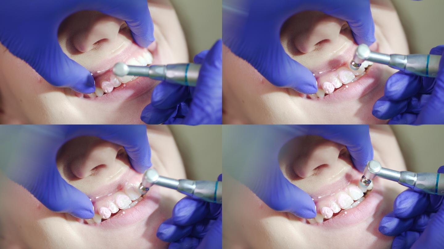 牙科诊所专业清除牙菌斑。