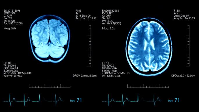 医学显示器上的两张mri脑部扫描图片