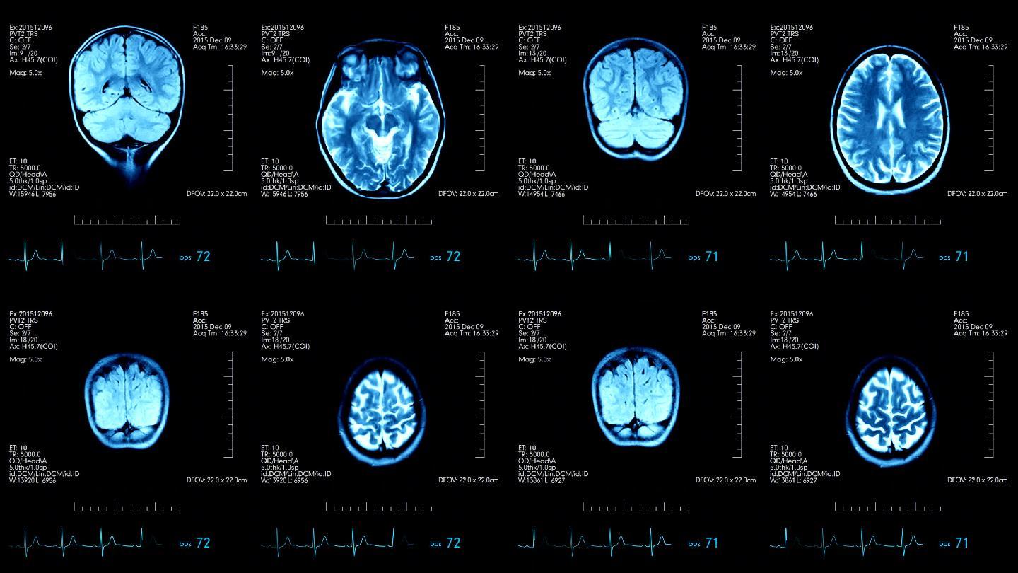 医学显示器上的两张mri脑部扫描图片