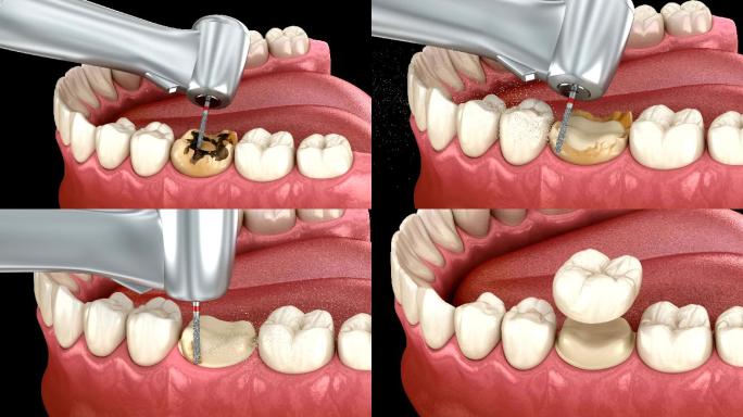 龋齿去除过程变形链球菌修复设备-破裂口腔