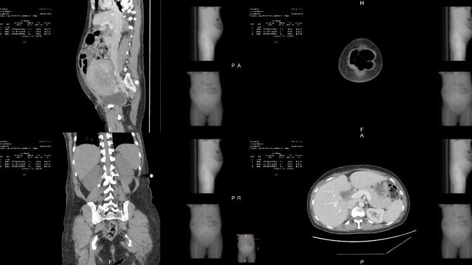 断层扫描人体透视黑白