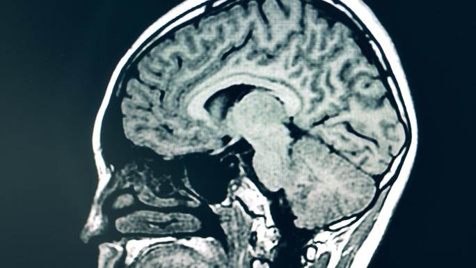 CT扫描时人脑的动态图像