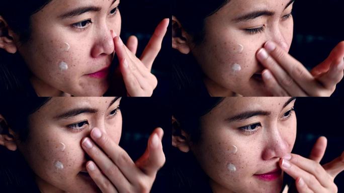 女性在脸上涂抹粉刺膏治疗粉刺和炎症