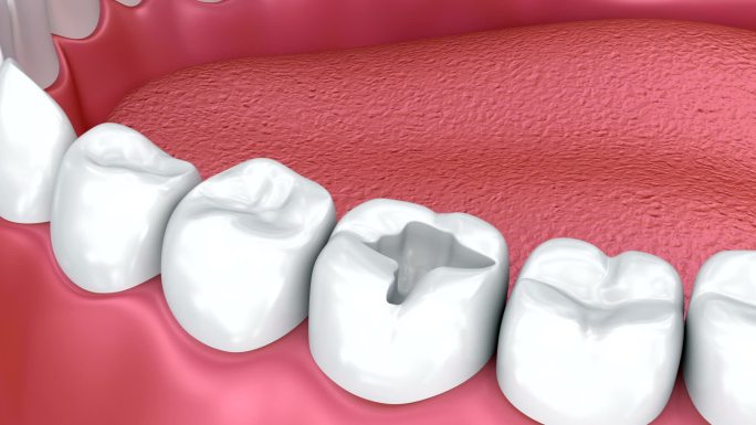 牙齿填充物牙科广告宣传片牙龈