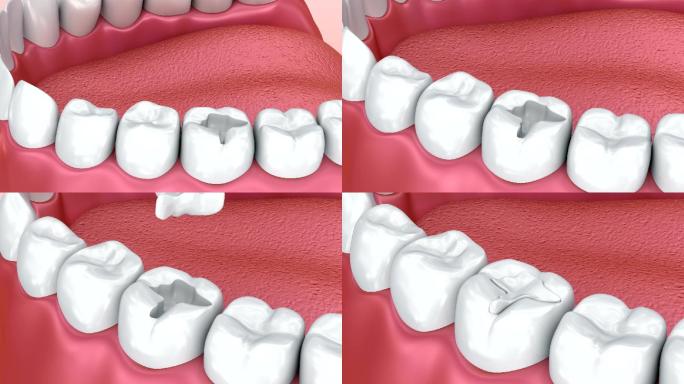 牙齿填充物牙科广告宣传片牙龈