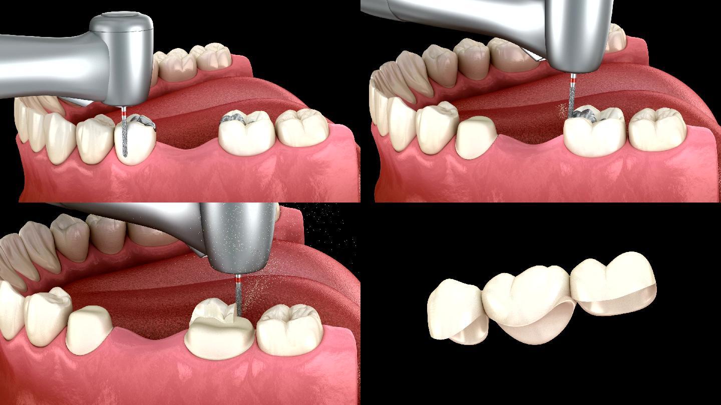 医学上精确的换牙3D动画